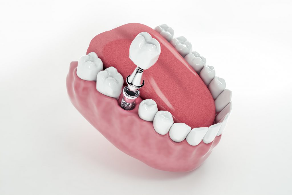 Caring for Dental Implants Essential Tips Dentaprime UK