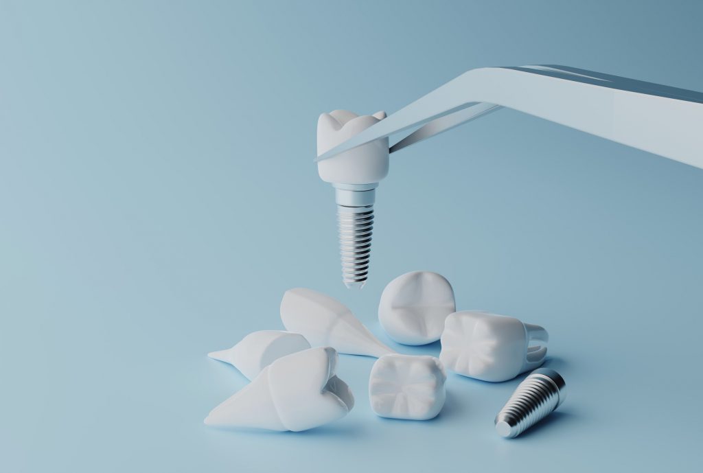 Dental Implant Recovery Essential Guidelines Dentaprime UK