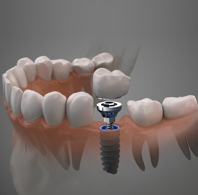 Dental Implants