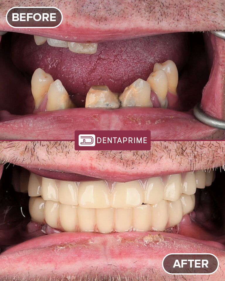 Fixed Teeth in a Day